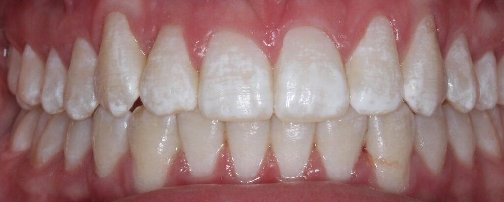skæve tænder er rettet før og efter tandregulering hos Østerbro tandregulering